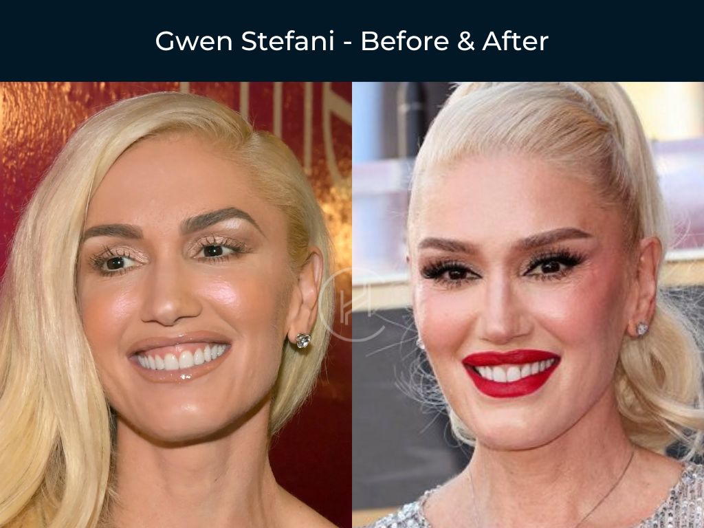 gwen-stefani-dental-before-after
