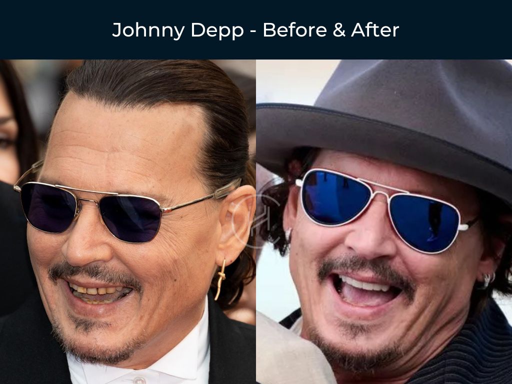 johnny-depp-dental-before-after