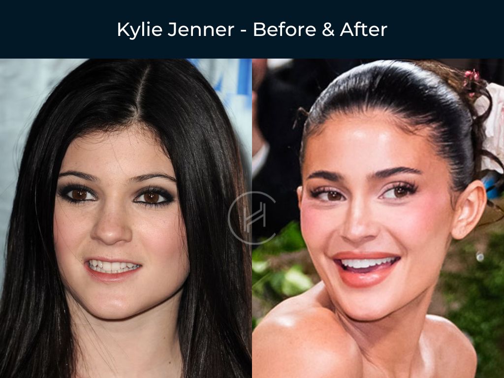 kylie-jenner-smile-makeover-before-after kylie jenner smile makeover before after