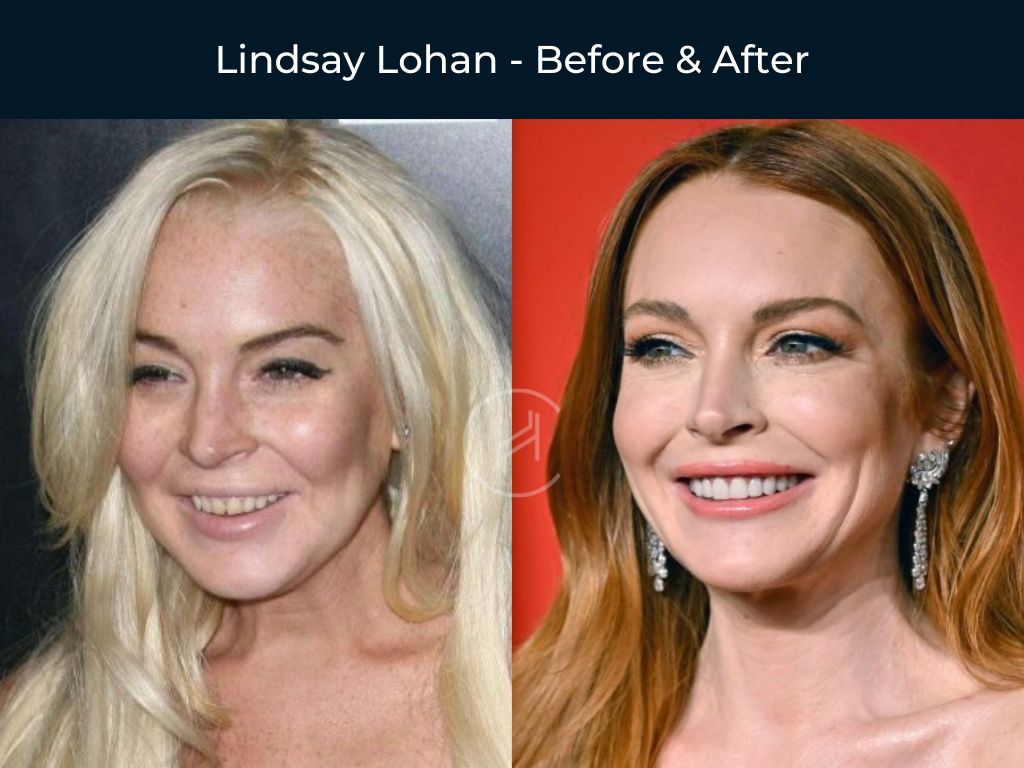 lindsay-lohan-dental-before-after lindsay lohan dental before after