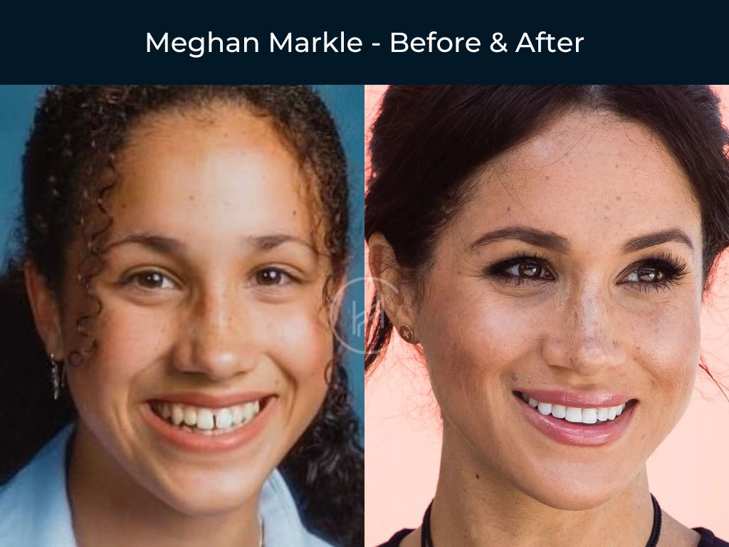 meghan-markle-smile-makeover-before-after