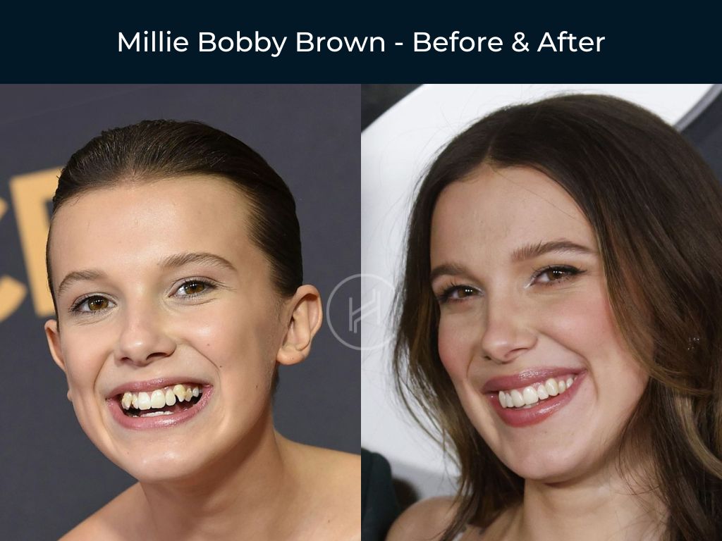 millie-bobby-brown-dental-before-after millie bobby brown dental work before after