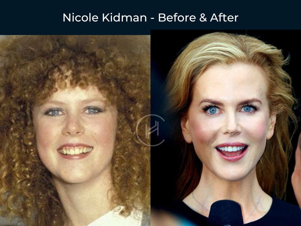 nicole-kidman-dental-before-after nicole kidman dental before after