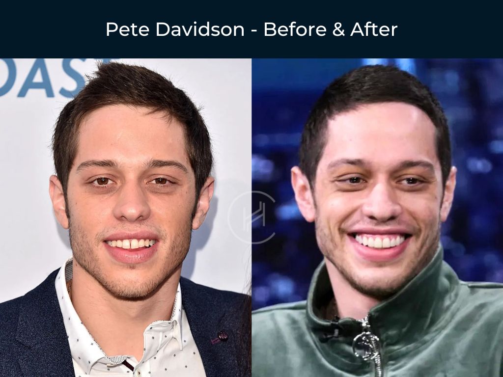 pete-davidson-dental-before-after pete davidson dental before after