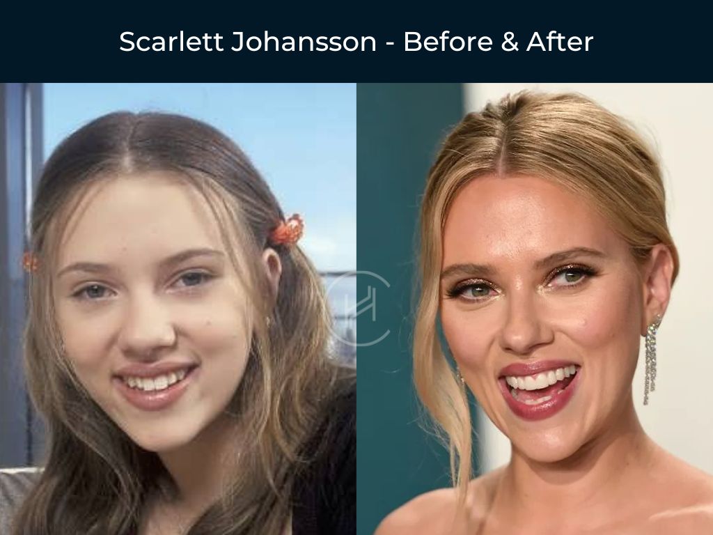 scarlett-johansson-dental-before-after scarlett johansson dental before after