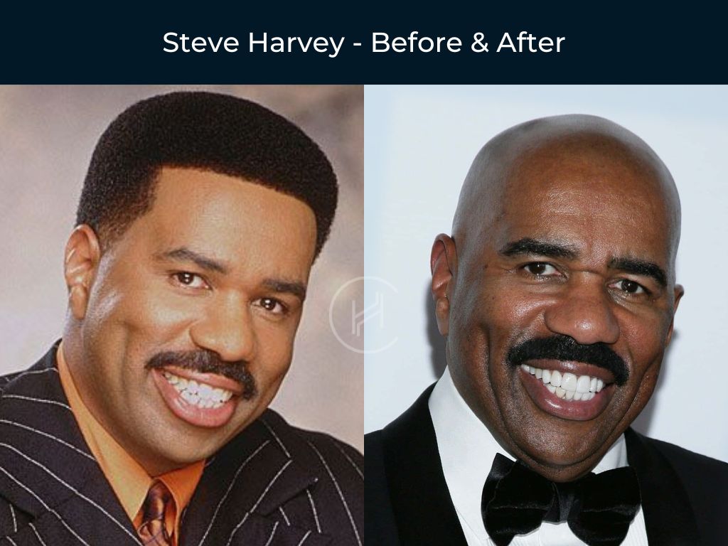 steve-harvey-teeth-before-after steve harvey teeth and smile before after