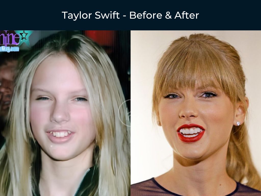 taylor-swift-dental-veneers-before-after taylor swift dental veneers before after