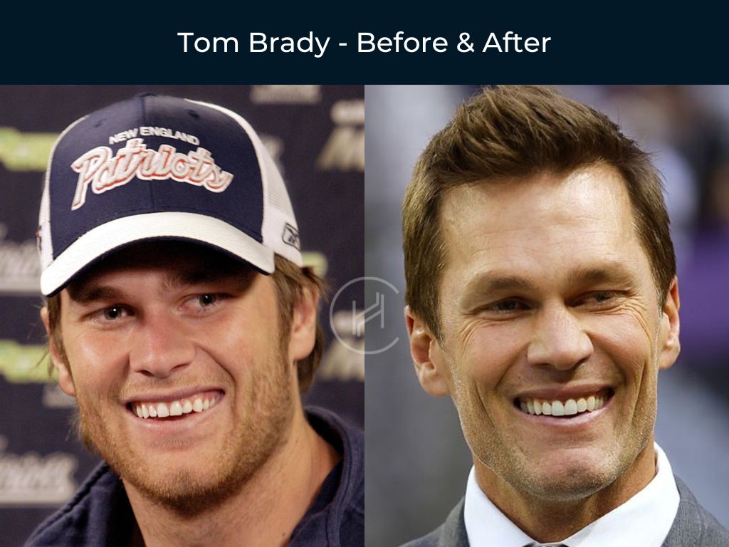 tom-brady-dental-before-after tom brady dental work before and after