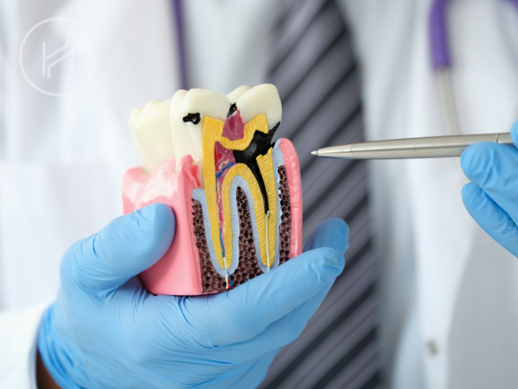 tooth cavity for dental filling demonstration tooth cavity for dental filling demonstration