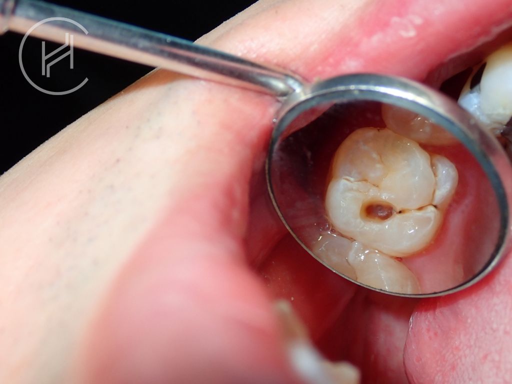tooth cavity for dental filling