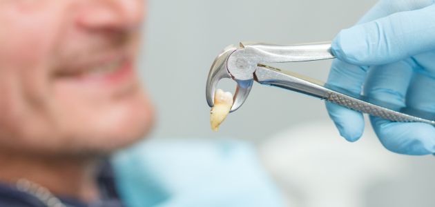 tooth extraction process banner