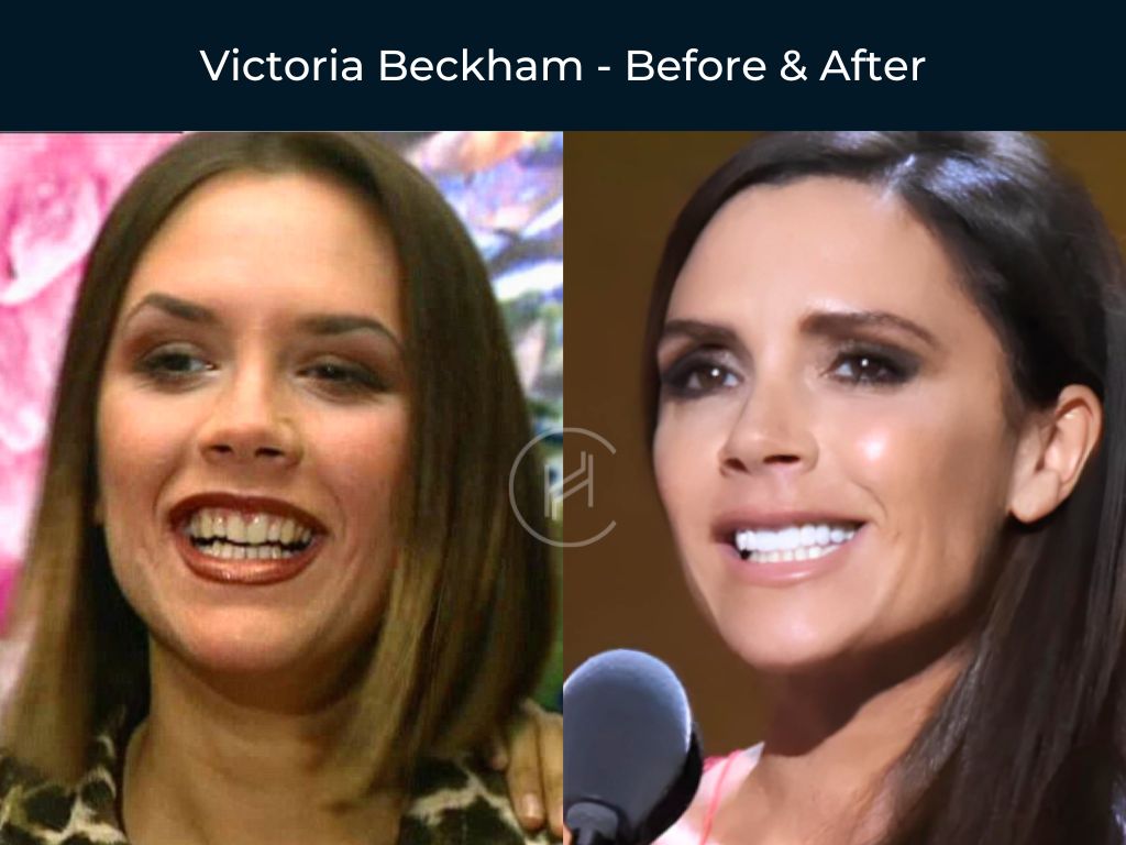 victoria-beckham-dental-before-after victoria beckham dental before after