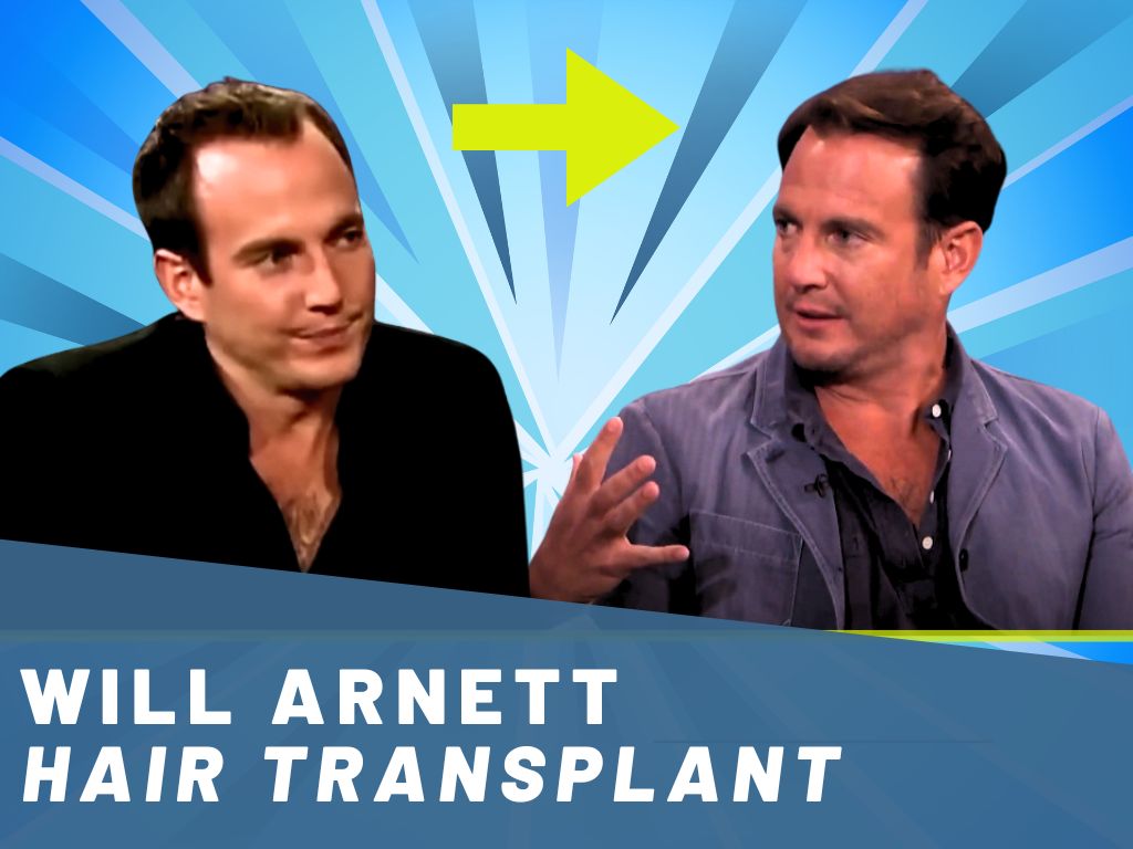 will arnett hair transplant analysis banner