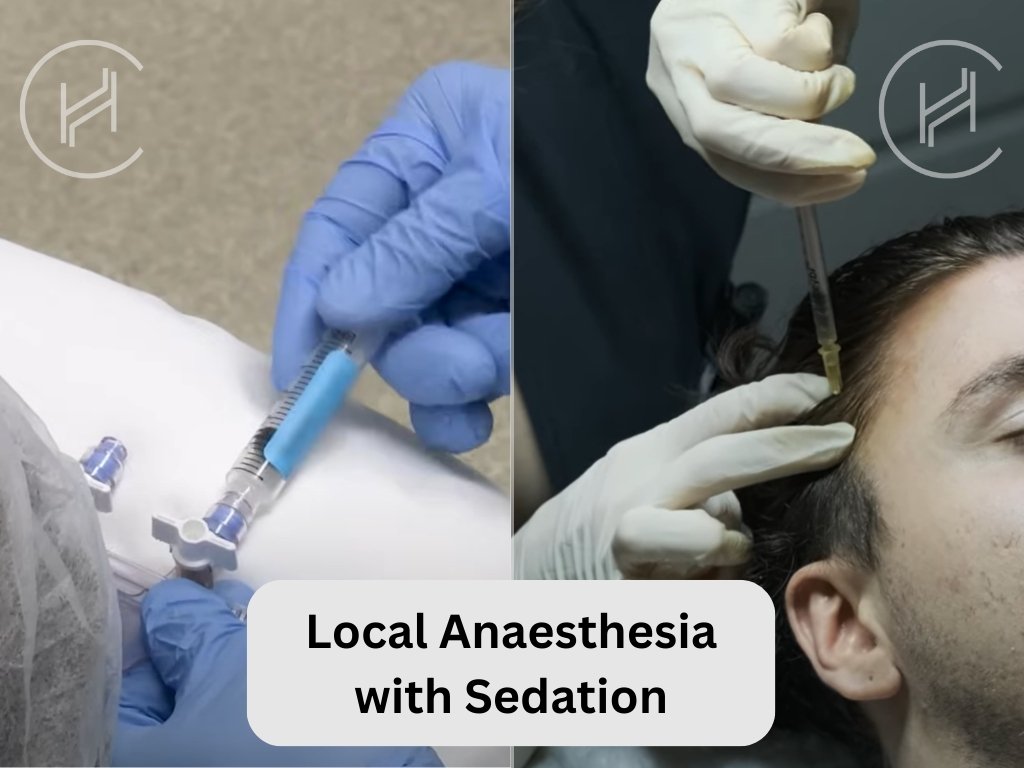 Local Anaesthesia with Sedation for Hair Transplant