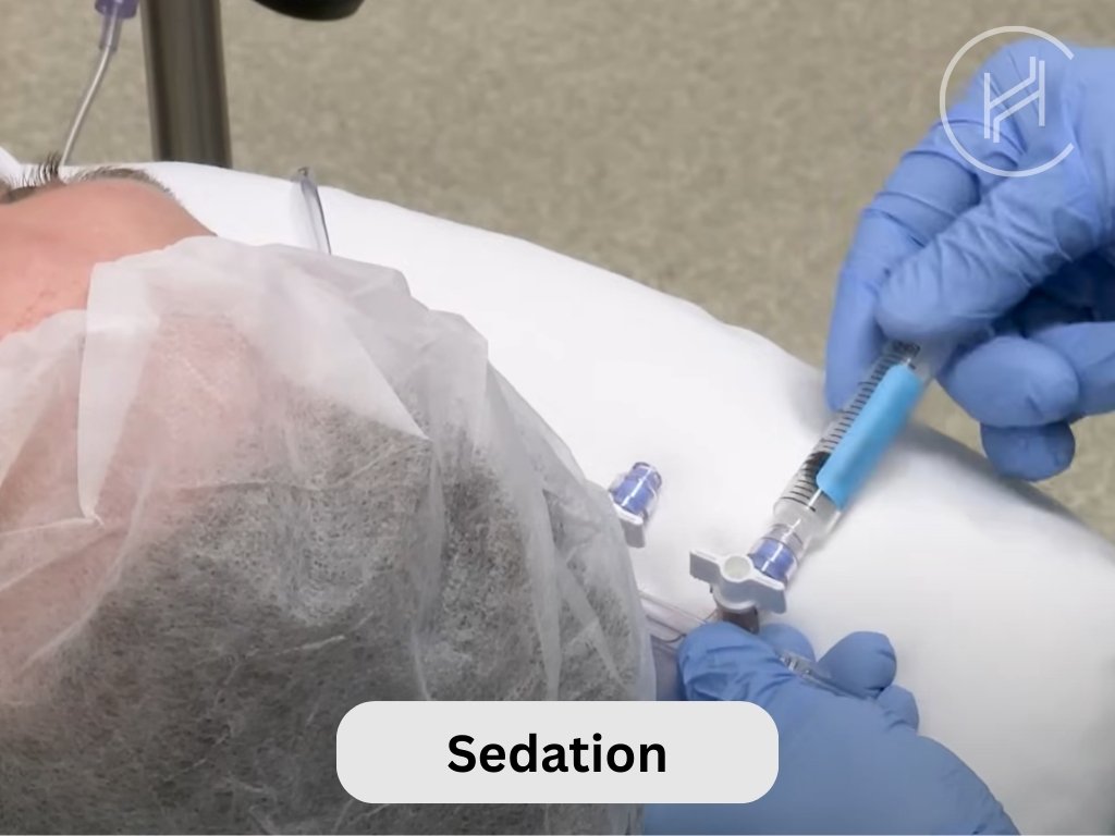Sedation for Hair Transplant