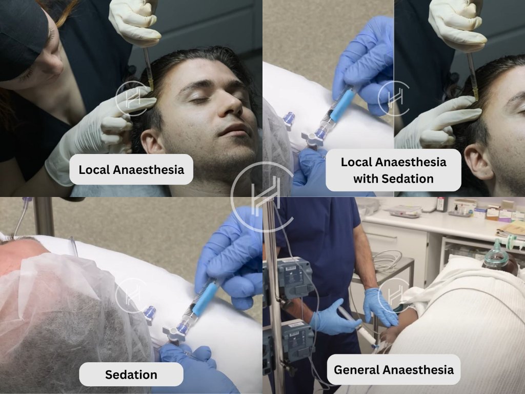 Types of Anaesthesia Used in Hair Transplants