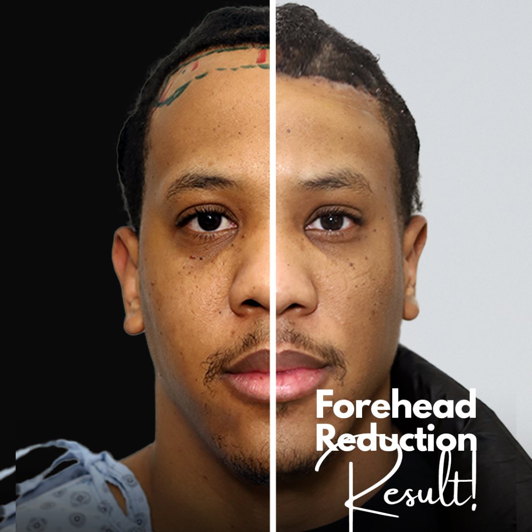 afro male forehead reduction before and after result