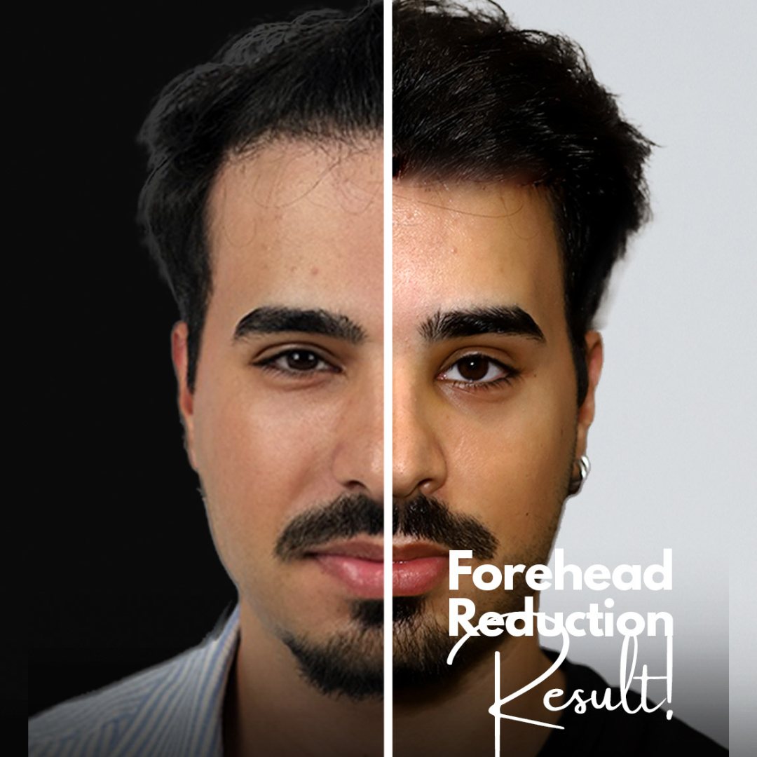 curly hair male hairline lowerin surgery result