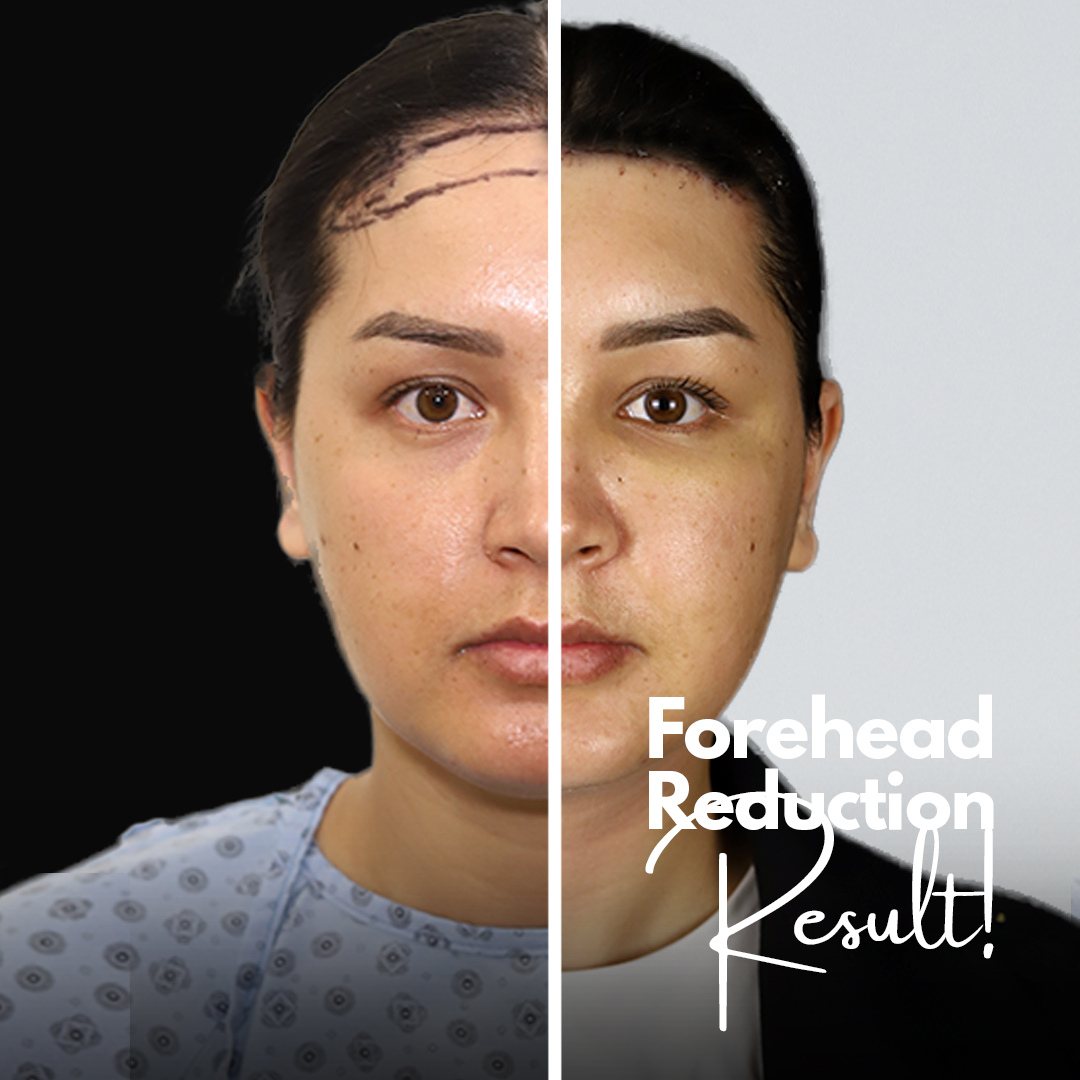 female forehead reduction operation result