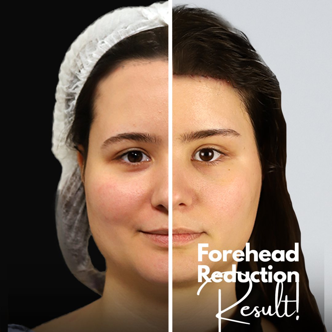 female forehead reduction surgery hairline lowering result