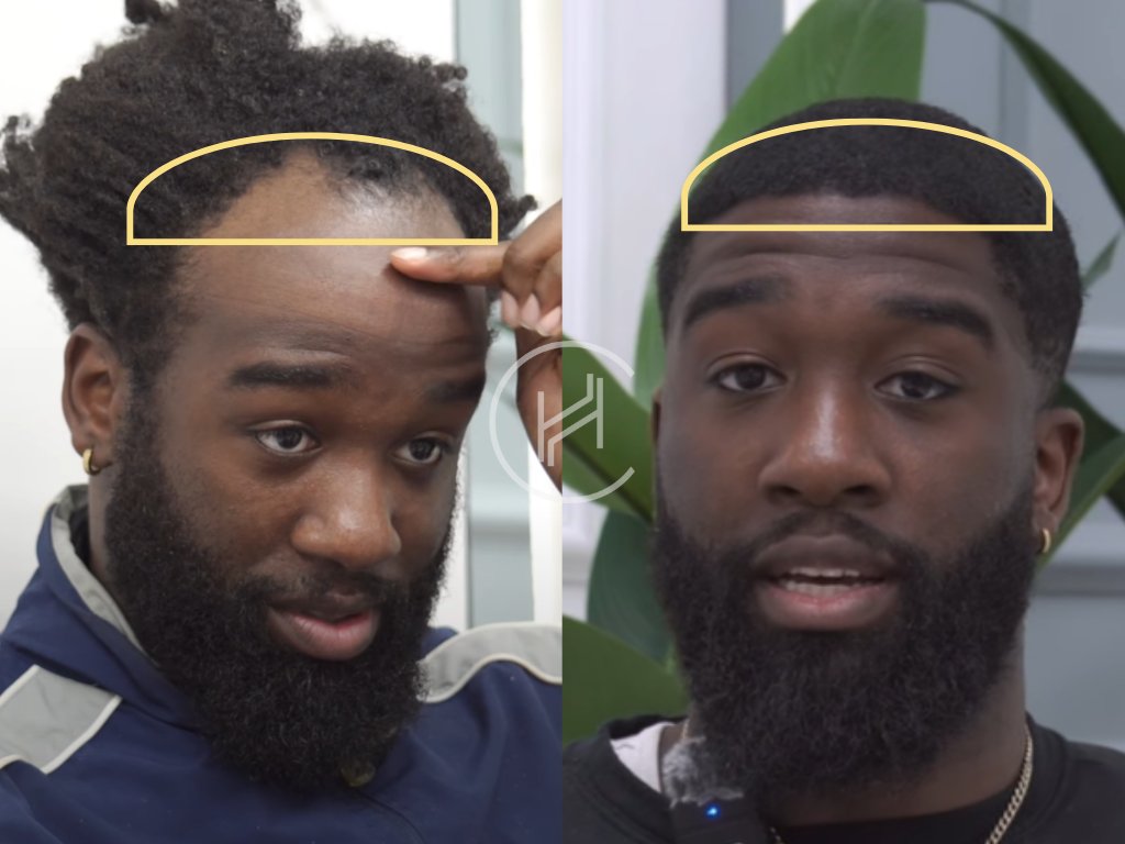 Afro hair transplant before and after hairline