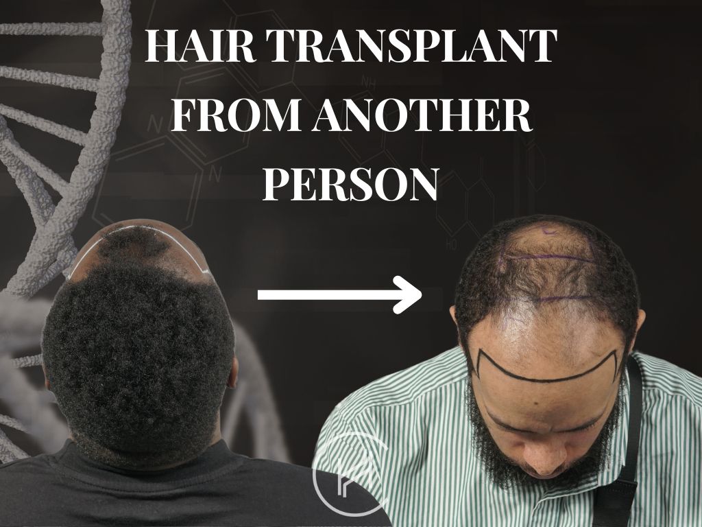 Hair Transplant from Another Person Banner