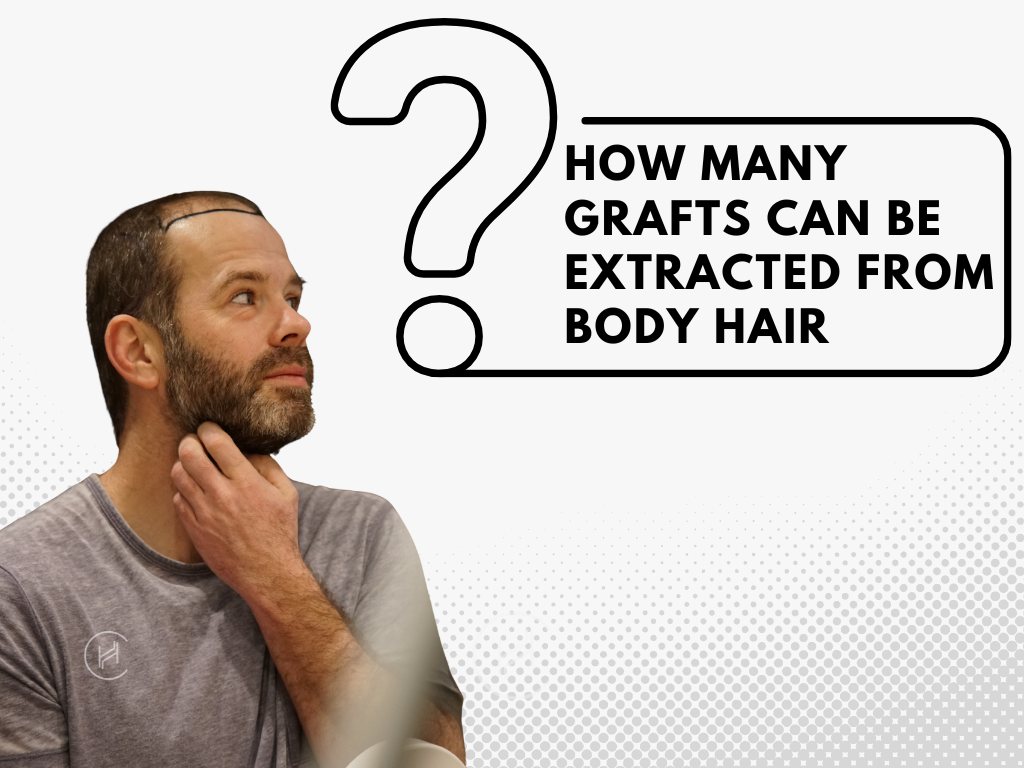 How many grafts can be extracted from body hair question How many grafts can be extracted from body hair question