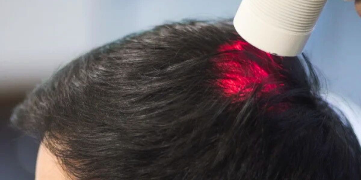 Low-Level Laser Therapy for Scalp and Hair