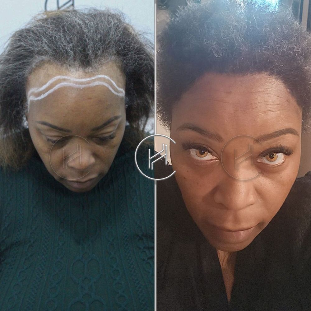 Scarring (Cicatricial) Alopecia Hair Transplant Before and After Afro female result