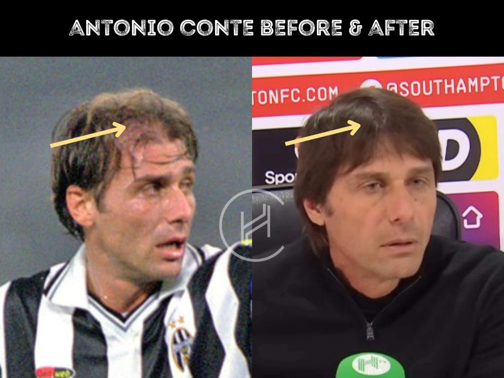 antonio conte before and after hair transplant photo