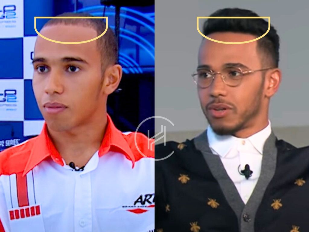 lewis hamilton before after hair transplant hair evolution