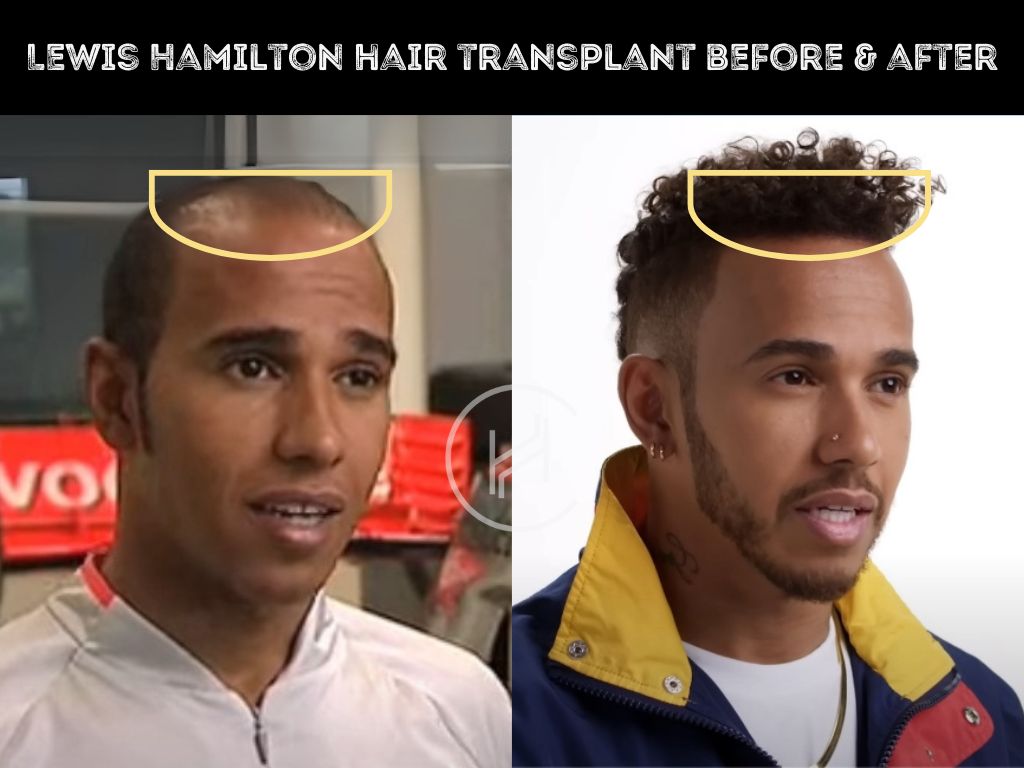 lewis-hamilton-before-and-after-hair-transplant-result lewis hamilton before and after hair transplant result