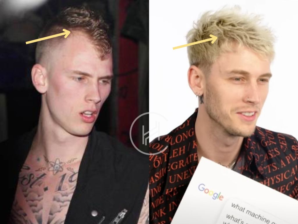 machine gun kelly before after hair transplant photo