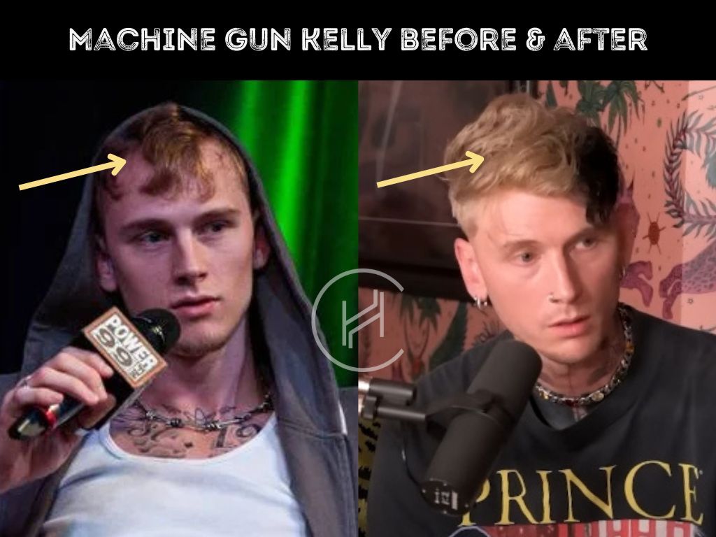 mgk hair transplant befor and after photo