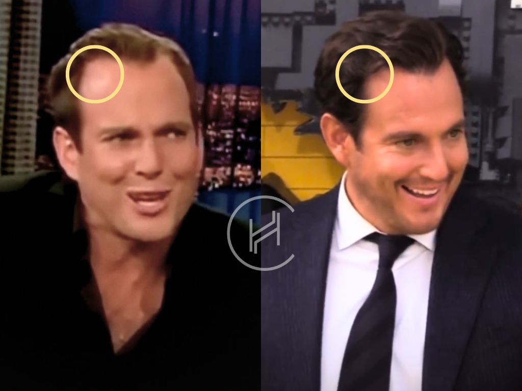 will arnett hair transplant before after photo