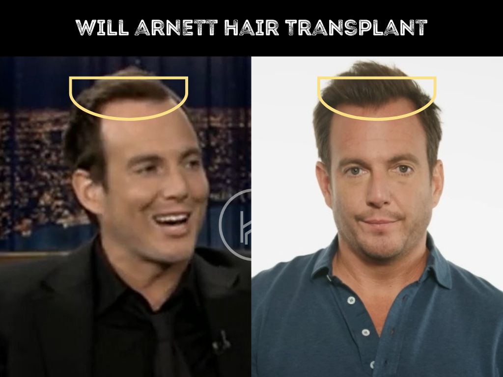 will arnett - hair transplant before and after result