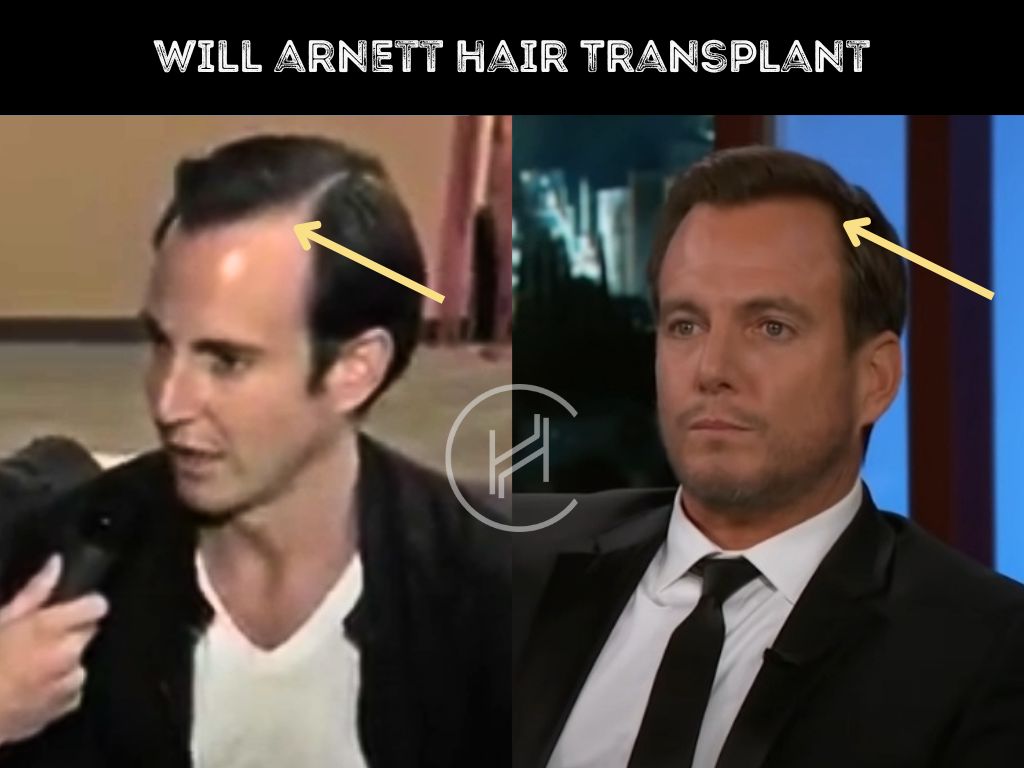 will arnett hair transplant before and after result