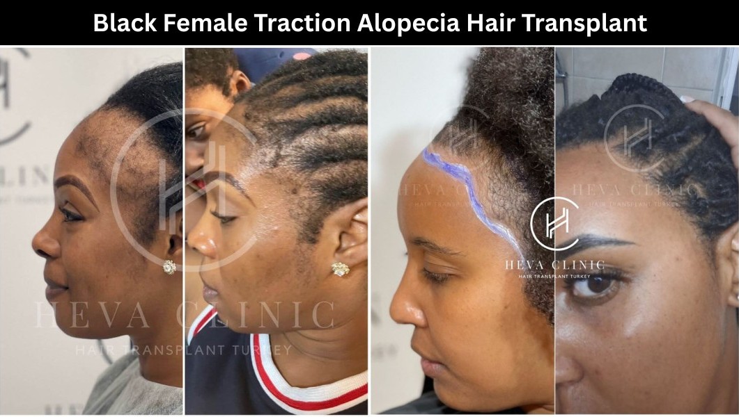 Black Female Traction Alopecia Hair Transplant Before and After Black Female Traction Alopecia Hair Transplant Before and After Result