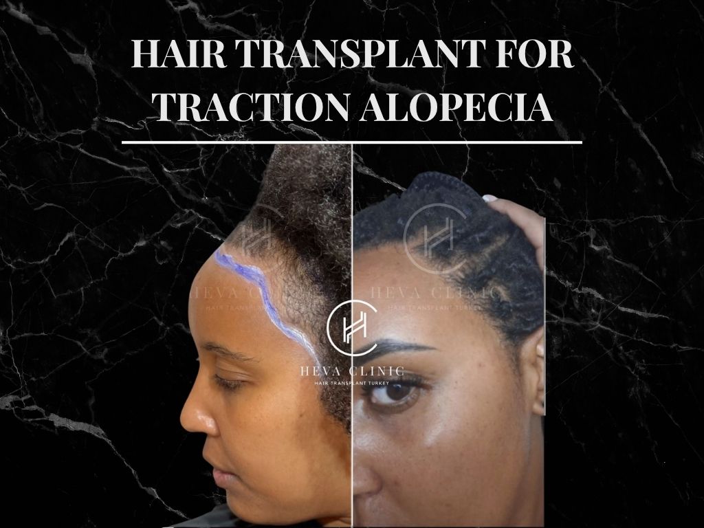 Hair Transplant for Traction Alopecia Black Banner