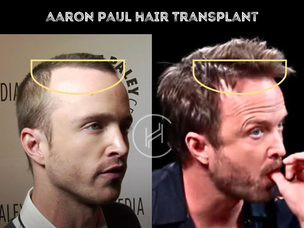 aaron paul hair transplant before and after