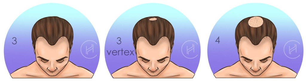norwood stage 3 and 3 vertex and four image