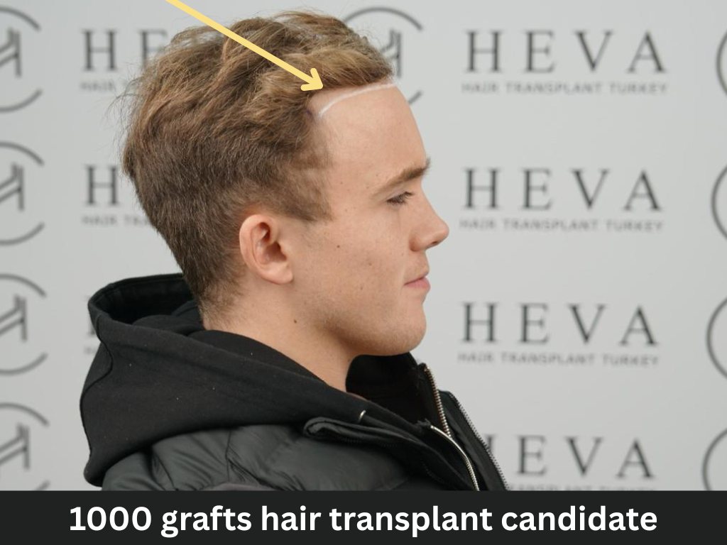 1000 grafts hair transplant candidate side 1000 grafts hair transplant candidate side