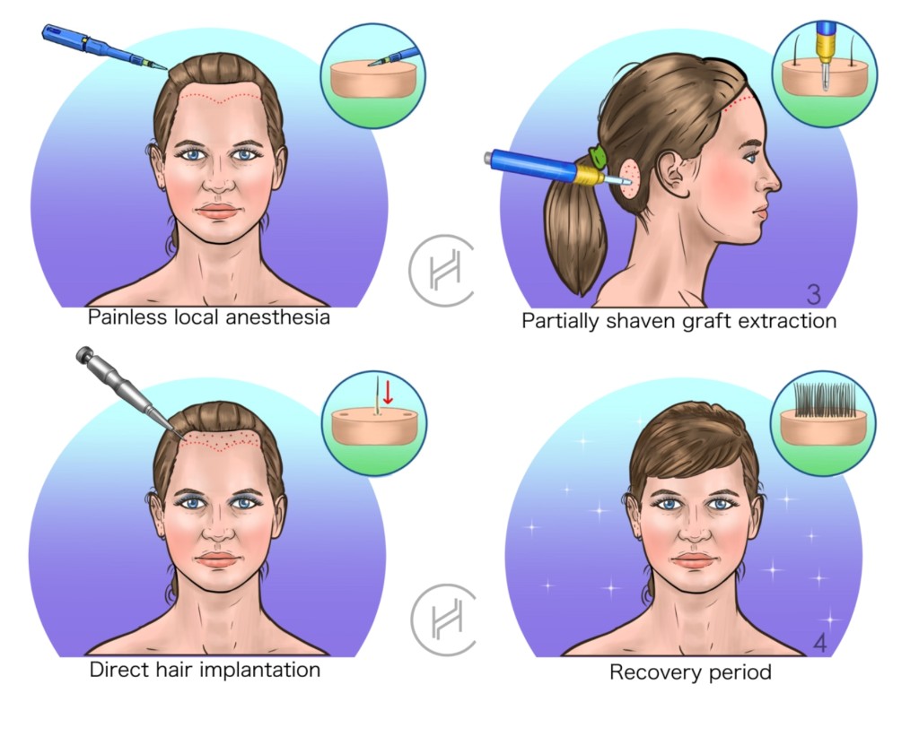 female dhi hair transplant process steps
