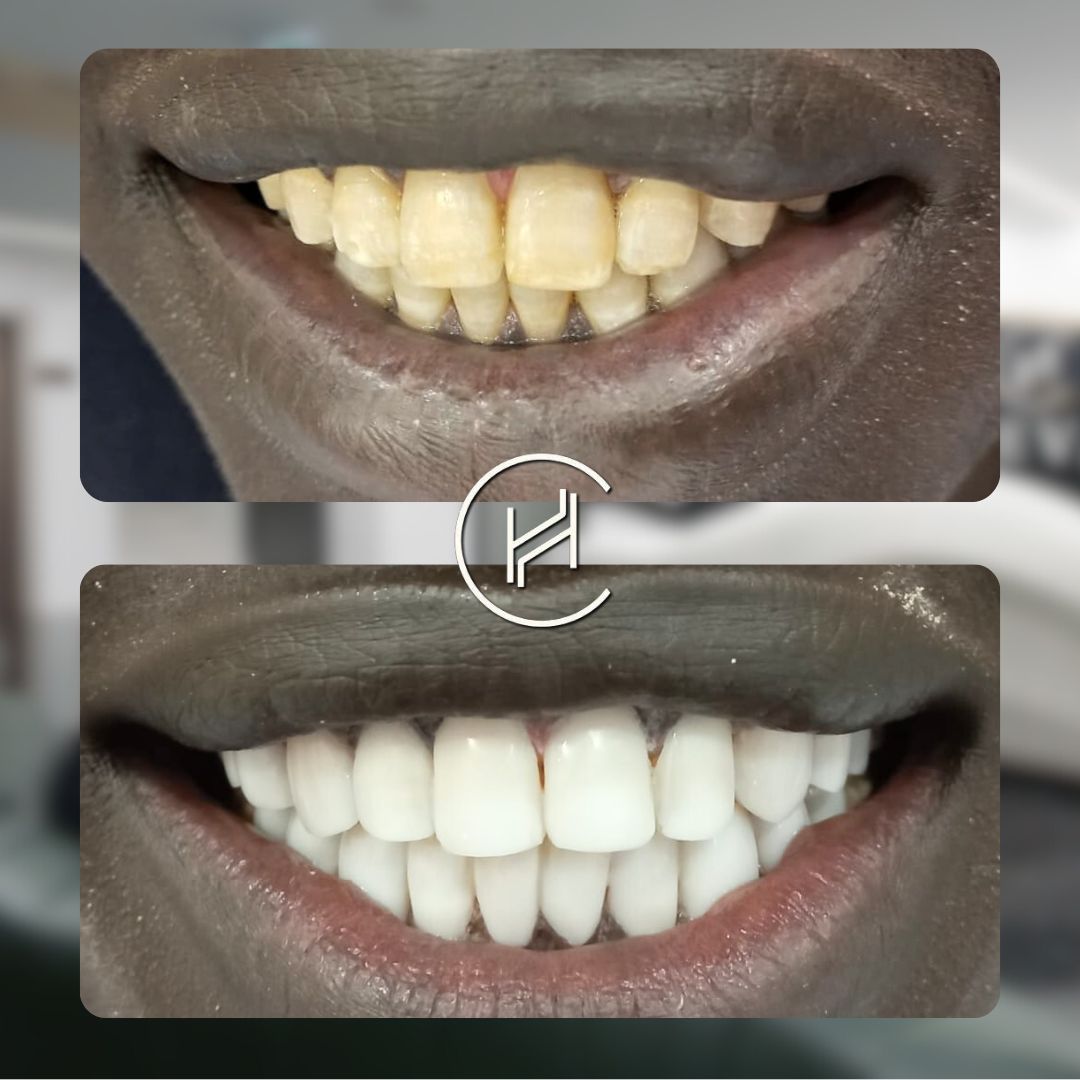 20 composite bonding dental treatment at heva clinic