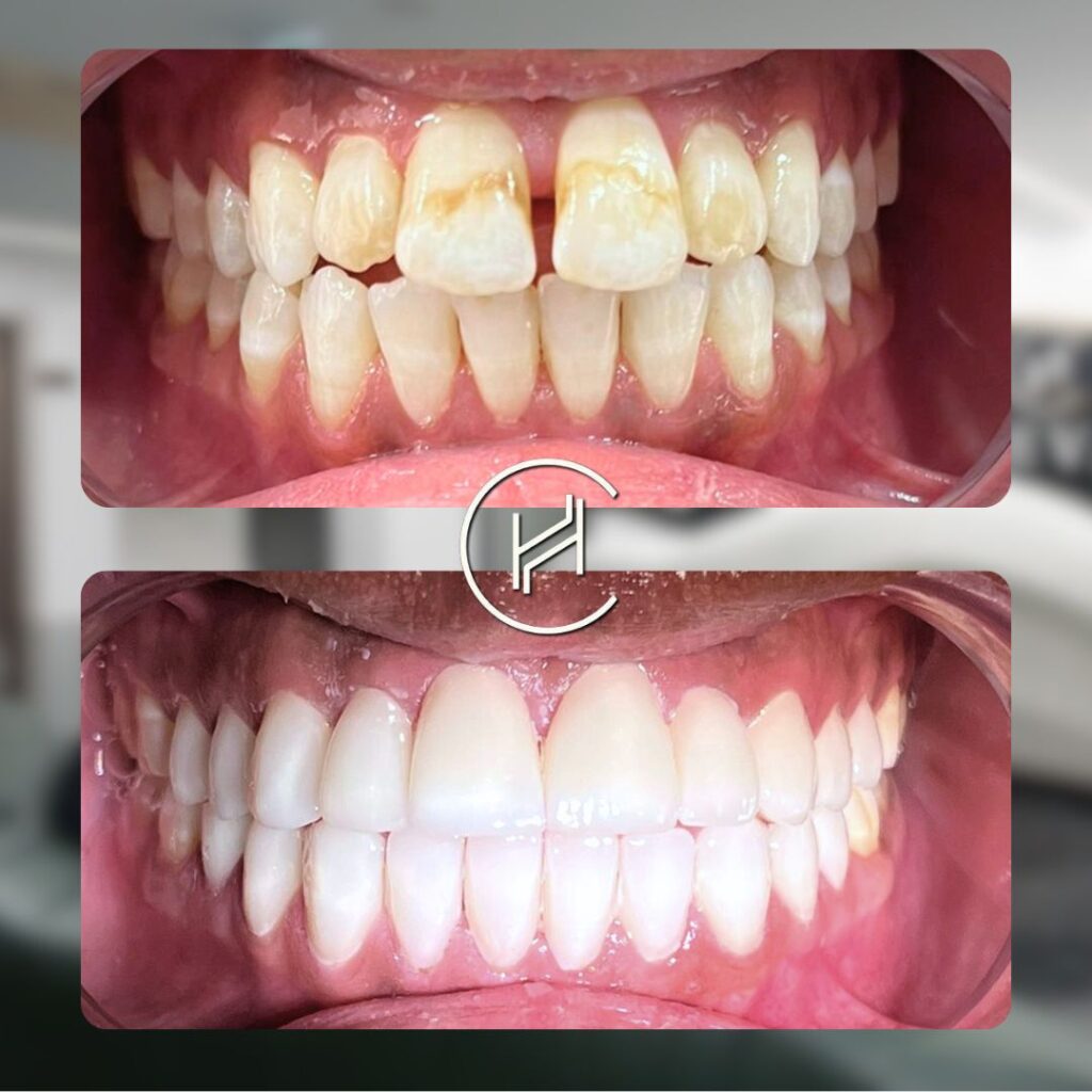 20 dental veneer before and after 20 dental veneer before and after result closueup