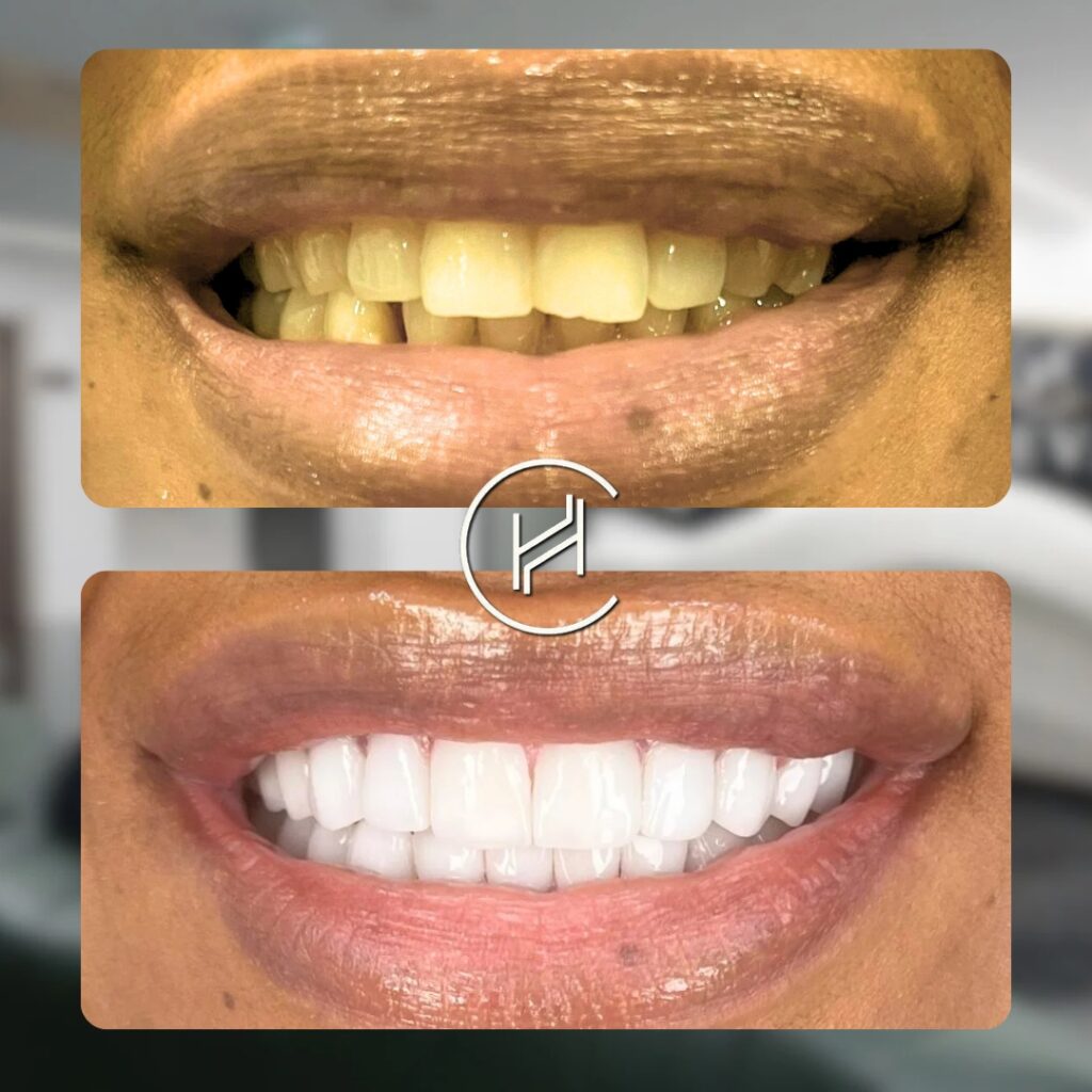 20 dental veneer result before and after photo heva clinic turkey 20 dental veneer result before and after photo heva clinic turkey
