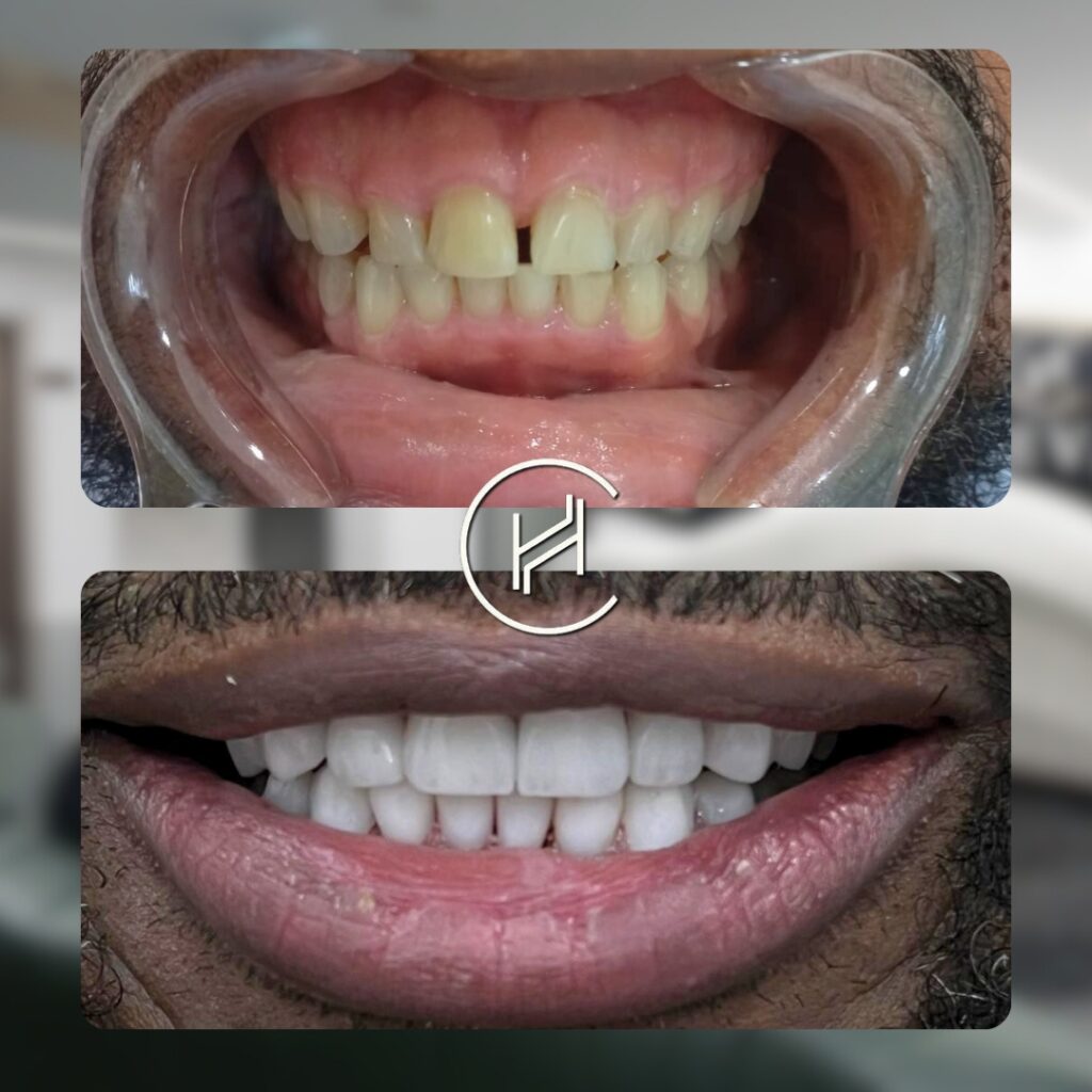 20 veneer 12 gingivectomy dental treatment heva clinic istanbul 20 veneer 12 gingivectomy dental treatment heva clinic istanbul
