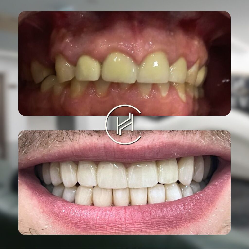 20 veneer and 12 gingivectomy treatment heva dental clinic 20 veneer and 12 gingivectomy treatment heva dental clinic