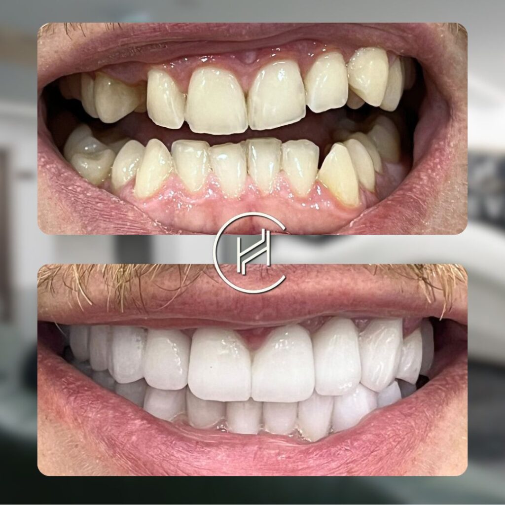 21 Zirconium Crowns at heva clinic turkey 21 Zirconium Crowns at heva clinic turkey