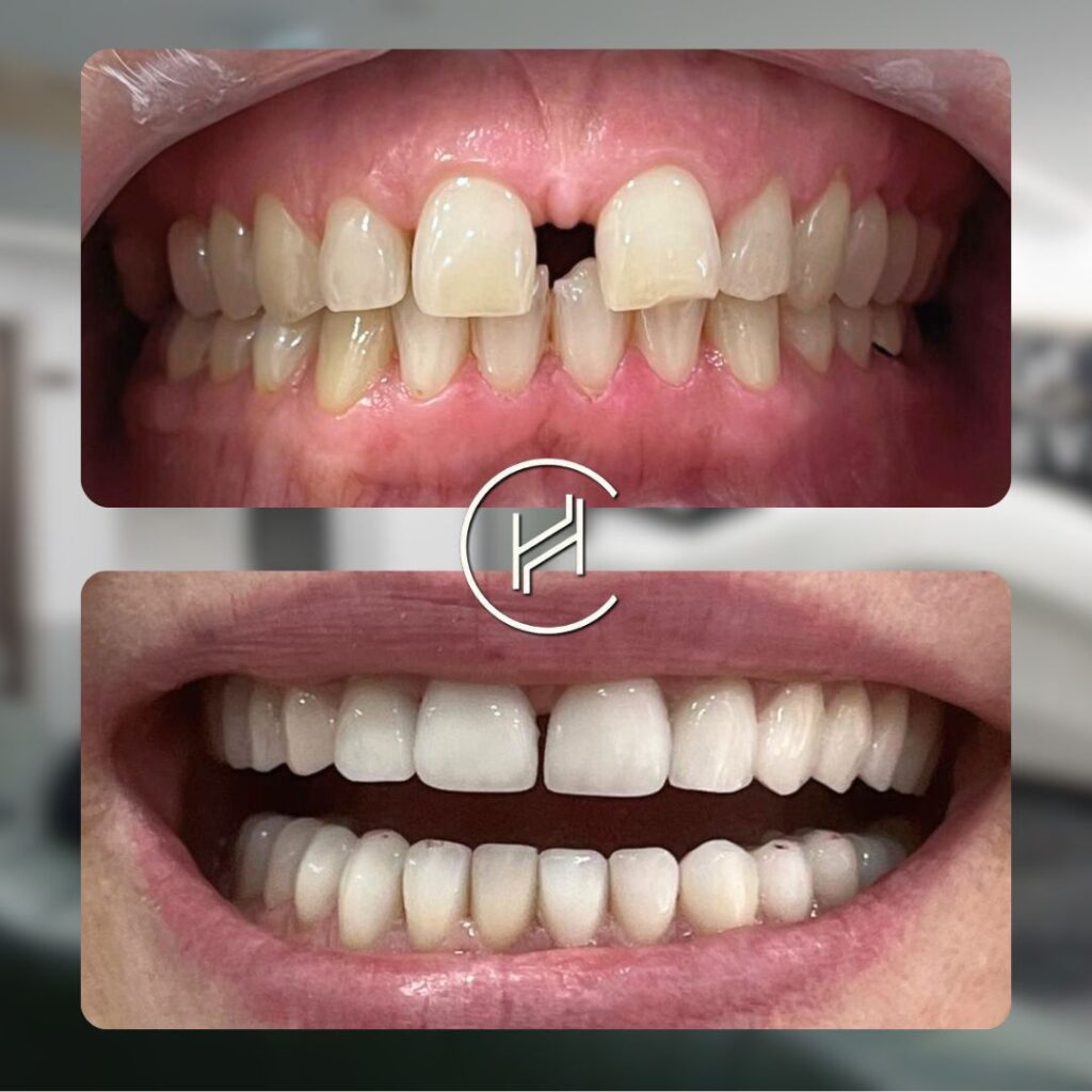 24 emax crowns dental treatment heva clinic turkey 24 emax crowns dental treatment heva clinic turkey